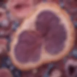 Histological slide showcasing pancreatic adenocarcinoma cells