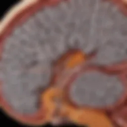 MRI scan highlighting lesions typical in Multiple Sclerosis