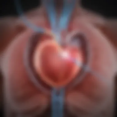 Illustration of RF ablation catheter navigating the heart