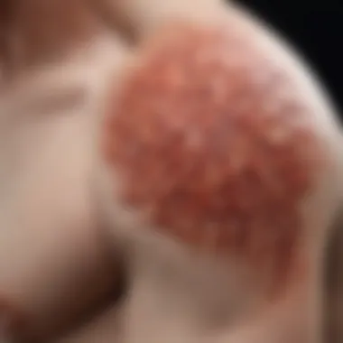 Inflammation in Psoriasiform Dermatitis An intricate dermal structure highlighting inflammation associated with psoriasiform dermatitis.