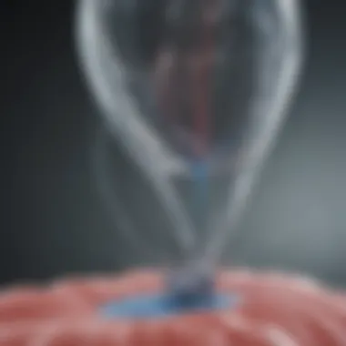 Balloon Stent Deployment in Action Visual representation of balloon stent deployment in a vascular procedure